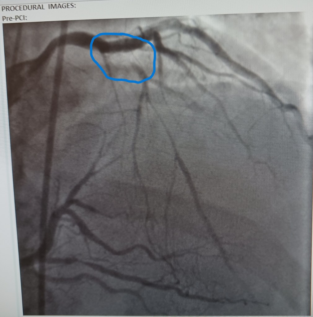Before stent, showing blockage